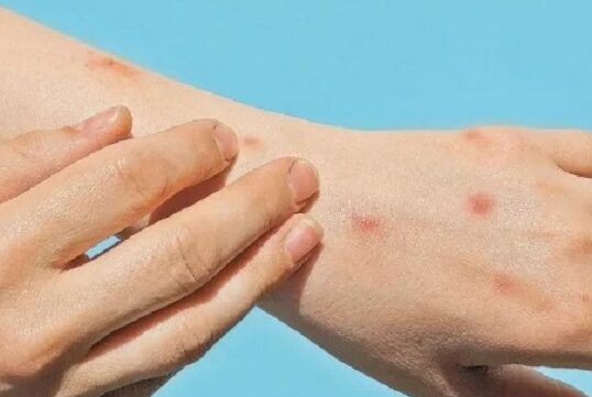 Mpox से बचना है तो अपनाएं ये उपाय,,वरना आपके घर तक पहुंच सकती है ये खतरनाक बीमारी!