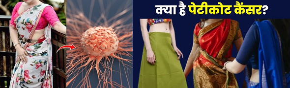 सावधान ! महिलाओं में हो रहा ‘पेटीकोट कैंसर’